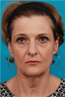 Facelift Before Photo by Michael Bogdan, MD, MBA, FACS; Grapevine, TX - Case 31849