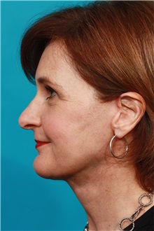 Facelift After Photo by Michael Bogdan, MD, MBA, FACS; Grapevine, TX - Case 31849