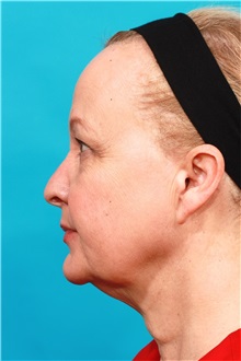 Facelift Before Photo by Michael Bogdan, MD, MBA, FACS; Grapevine, TX - Case 31850