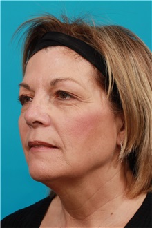 Facelift Before Photo by Michael Bogdan, MD, MBA, FACS; Grapevine, TX - Case 31851