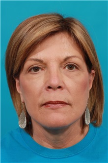 Facelift After Photo by Michael Bogdan, MD, MBA, FACS; Grapevine, TX - Case 31851
