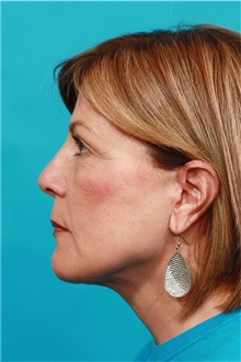 Facelift After Photo by Michael Bogdan, MD, MBA, FACS; Grapevine, TX - Case 31851