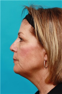 Facelift Before Photo by Michael Bogdan, MD, MBA, FACS; Grapevine, TX - Case 31851