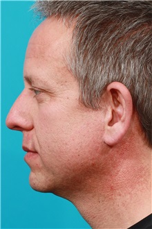 Facelift After Photo by Michael Bogdan, MD, MBA, FACS; Grapevine, TX - Case 31853
