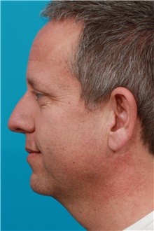 Facelift Before Photo by Michael Bogdan, MD, MBA, FACS; Grapevine, TX - Case 31853