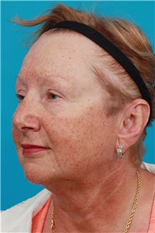 Facelift Before Photo by Michael Bogdan, MD, MBA, FACS; Grapevine, TX - Case 31854