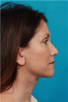 Facelift After Photo by Michael Bogdan, MD, MBA, FACS; Grapevine, TX - Case 31855
