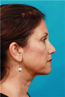 Facelift Before Photo by Michael Bogdan, MD, MBA, FACS; Grapevine, TX - Case 31855