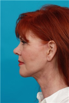 Facelift After Photo by Michael Bogdan, MD, MBA, FACS; Grapevine, TX - Case 31856
