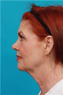 Facelift Before Photo by Michael Bogdan, MD, MBA, FACS; Grapevine, TX - Case 31856