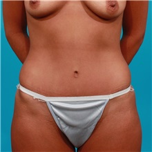 Tummy Tuck After Photo by Michael Bogdan, MD, MBA, FACS; Grapevine, TX - Case 31857
