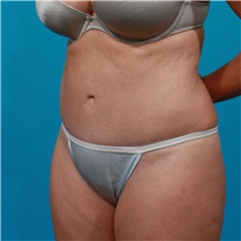 Tummy Tuck After Photo by Michael Bogdan, MD, MBA, FACS; Grapevine, TX - Case 31858