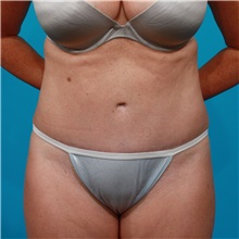Tummy Tuck After Photo by Michael Bogdan, MD, MBA, FACS; Grapevine, TX - Case 31858