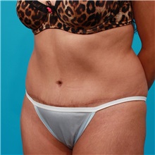 Tummy Tuck After Photo by Michael Bogdan, MD, MBA, FACS; Grapevine, TX - Case 31859