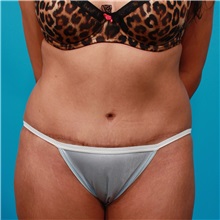 Tummy Tuck After Photo by Michael Bogdan, MD, MBA, FACS; Grapevine, TX - Case 31859