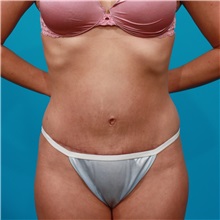 Tummy Tuck After Photo by Michael Bogdan, MD, MBA, FACS; Grapevine, TX - Case 31863