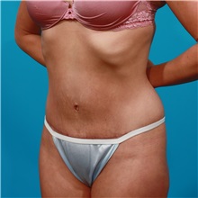 Tummy Tuck After Photo by Michael Bogdan, MD, MBA, FACS; Grapevine, TX - Case 31863