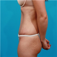 Tummy Tuck After Photo by Michael Bogdan, MD, MBA, FACS; Grapevine, TX - Case 31864