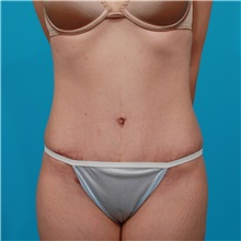 Tummy Tuck After Photo by Michael Bogdan, MD, MBA, FACS; Grapevine, TX - Case 31864