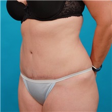 Tummy Tuck After Photo by Michael Bogdan, MD, MBA, FACS; Grapevine, TX - Case 31866