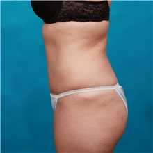 Tummy Tuck After Photo by Michael Bogdan, MD, MBA, FACS; Grapevine, TX - Case 31866