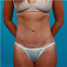 Tummy Tuck After Photo by Michael Bogdan, MD, MBA, FACS; Grapevine, TX - Case 31868