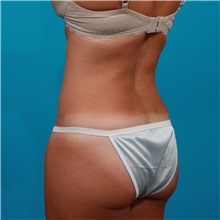 Tummy Tuck After Photo by Michael Bogdan, MD, MBA, FACS; Grapevine, TX - Case 31868