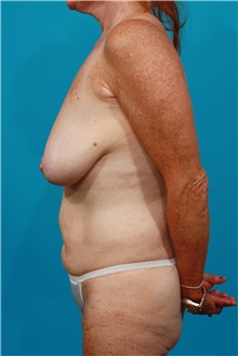 Tummy Tuck Before Photo by Michael Bogdan, MD, MBA, FACS; Grapevine, TX - Case 31869