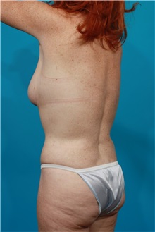 Tummy Tuck After Photo by Michael Bogdan, MD, MBA, FACS; Grapevine, TX - Case 31869