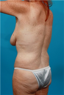 Tummy Tuck Before Photo by Michael Bogdan, MD, MBA, FACS; Grapevine, TX - Case 31869