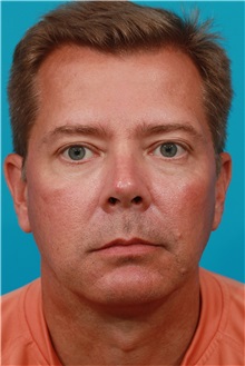 Eyelid Surgery After Photo by Michael Bogdan, MD, MBA, FACS; Grapevine, TX - Case 31873
