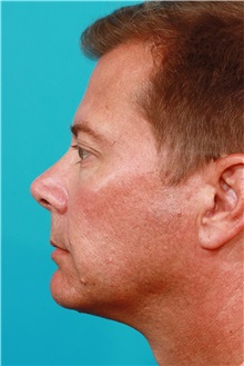 Eyelid Surgery After Photo by Michael Bogdan, MD, MBA, FACS; Grapevine, TX - Case 31873