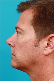 Eyelid Surgery Before Photo by Michael Bogdan, MD, MBA, FACS; Grapevine, TX - Case 31873
