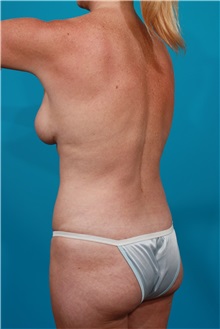 Tummy Tuck After Photo by Michael Bogdan, MD, MBA, FACS; Grapevine, TX - Case 31876