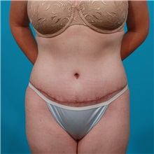 Tummy Tuck After Photo by Michael Bogdan, MD, MBA, FACS; Grapevine, TX - Case 31940