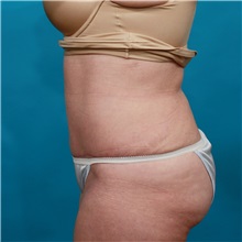 Tummy Tuck After Photo by Michael Bogdan, MD, MBA, FACS; Grapevine, TX - Case 31946