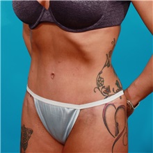 Tummy Tuck After Photo by Michael Bogdan, MD, MBA, FACS; Grapevine, TX - Case 31949