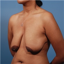 Breast Lift Before Photo by Michael Bogdan, MD, MBA, FACS; Grapevine, TX - Case 31950