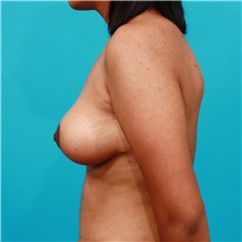 Breast Lift After Photo by Michael Bogdan, MD, MBA, FACS; Grapevine, TX - Case 31950