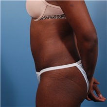 Tummy Tuck After Photo by Michael Bogdan, MD, MBA, FACS; Grapevine, TX - Case 31953