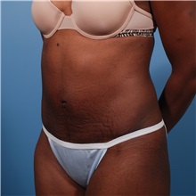 Tummy Tuck After Photo by Michael Bogdan, MD, MBA, FACS; Grapevine, TX - Case 31953