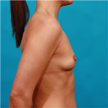 Breast Augmentation Before Photo by Michael Bogdan, MD, MBA, FACS; Grapevine, TX - Case 31955