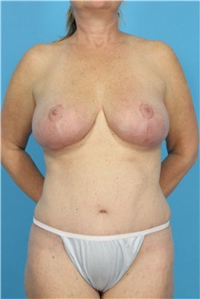 Tummy Tuck After Photo by Michael Bogdan, MD, MBA, FACS; Grapevine, TX - Case 31959