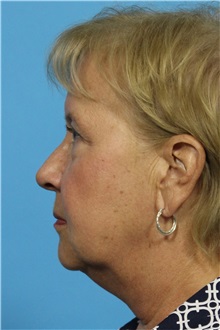 Facelift Before Photo by Michael Bogdan, MD, MBA, FACS; Grapevine, TX - Case 31965