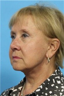 Facelift After Photo by Michael Bogdan, MD, MBA, FACS; Grapevine, TX - Case 31965
