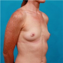 Breast Augmentation Before Photo by Michael Bogdan, MD, MBA, FACS; Grapevine, TX - Case 31968