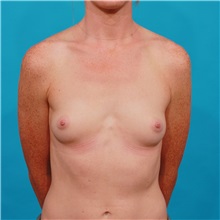 Breast Augmentation Before Photo by Michael Bogdan, MD, MBA, FACS; Grapevine, TX - Case 31968