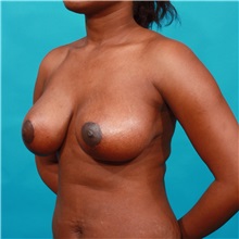 Breast Reduction After Photo by Michael Bogdan, MD, MBA, FACS; Grapevine, TX - Case 31970