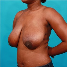Breast Reduction Before Photo by Michael Bogdan, MD, MBA, FACS; Grapevine, TX - Case 31970