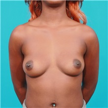 Breast Augmentation Before Photo by Michael Bogdan, MD, MBA, FACS; Grapevine, TX - Case 31971
